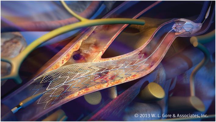 Study Compares Outcomes of Two Devices Used in Carotid Artery